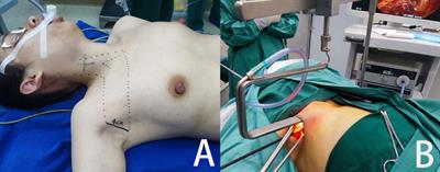 “Elastic stretch cavity building” system in endoscopic thyroidectomy via the axillary approach: a case series